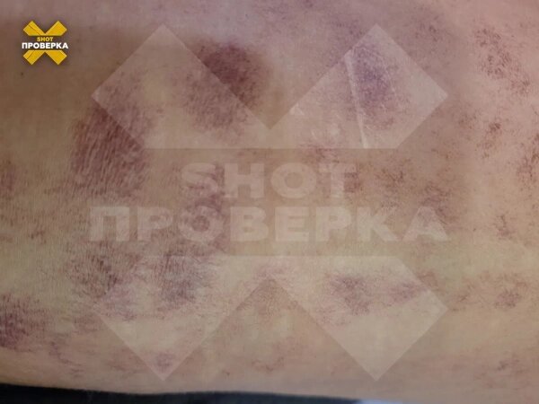 Девушка получила 40% после лазерной эпиляции. Фото © SHOT ПРОВЕРКА