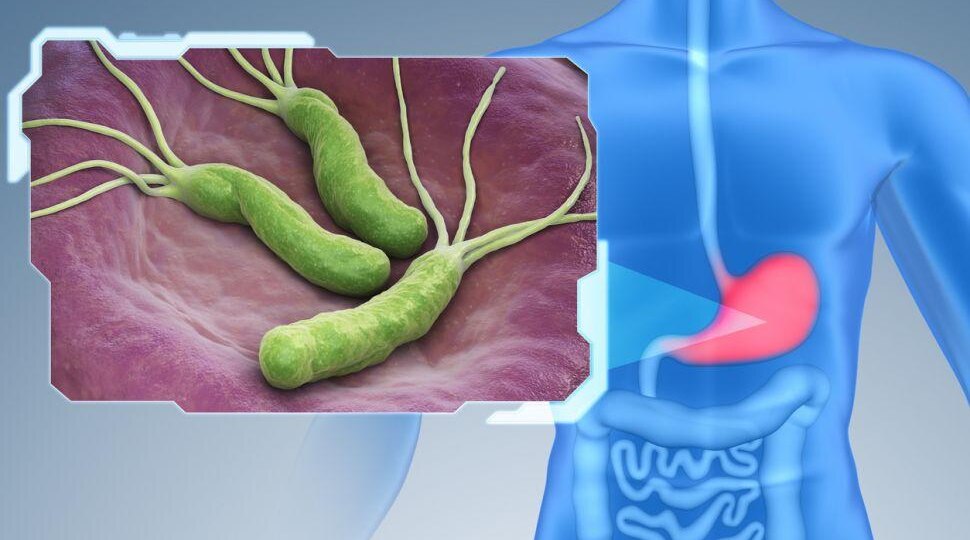 Как избавиться от Helicobacter pylori и чем она опасна?