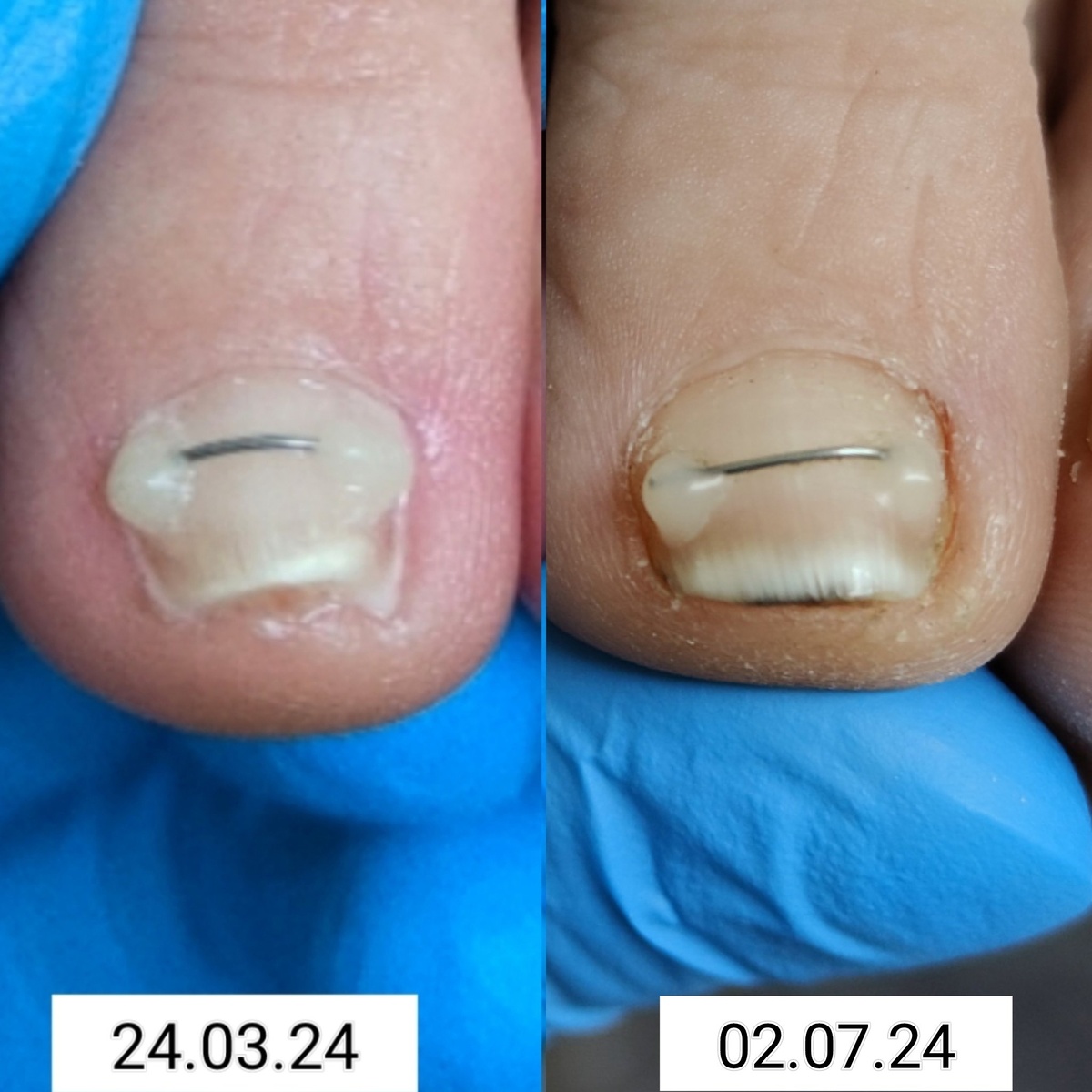 Динамика раскручивания ногтя с помощью титановой нити