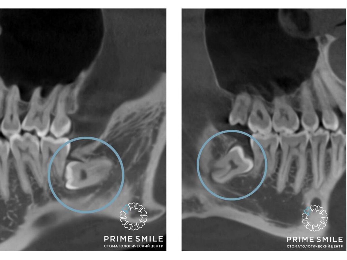 Ретинированные дистопированные зубы мудрости на нижней челюсти