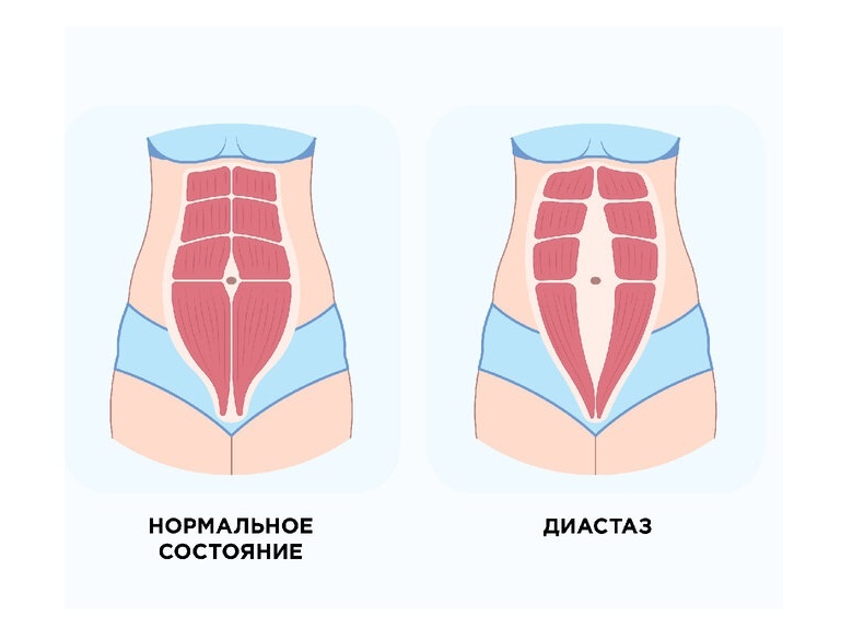 В норме расстояние между прямыми мышцами живота не должно превышать 2 см.