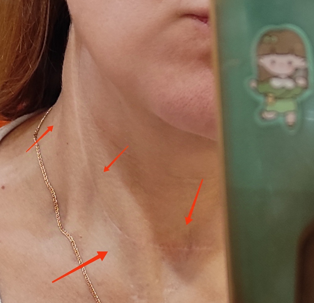 "Прошло два с половиной года после операции. Я жива! Живу обычной жизнью. Без ограничений. Можно даже ездить на юг, загорать, но без фанатизма. Напоминает о заболевании только это "колье" и таблетка за 30 минут до завтрака. И соль покупаю теперь не йодированную", - поделилась томичка.