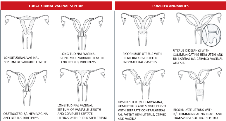 ASRM mullerian anomalies classification 2021
