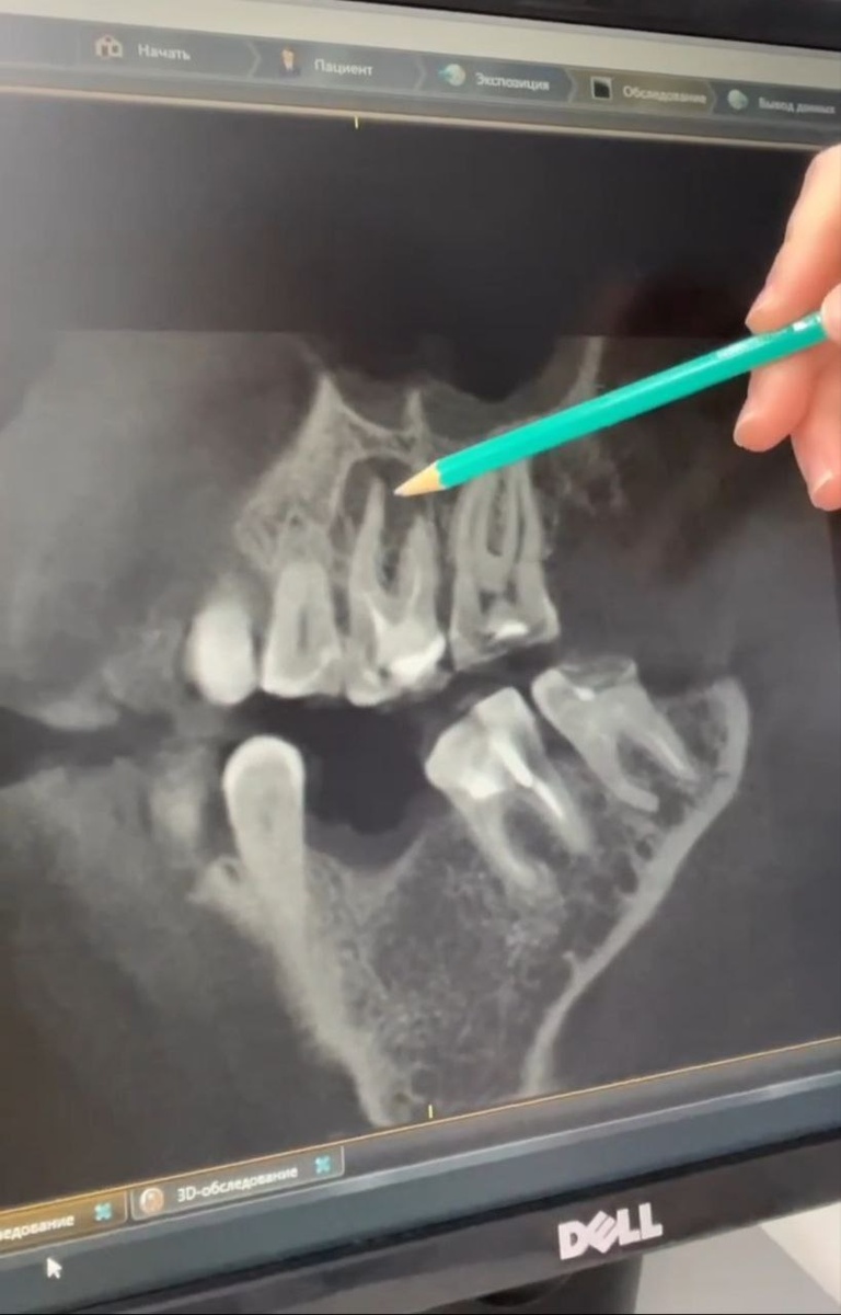 Фото 1 сделано до лечения, тёмное пятно на снимке - киста, фото 2 — уже после лечения, вокруг корня зуба образовалась костная ткань.

