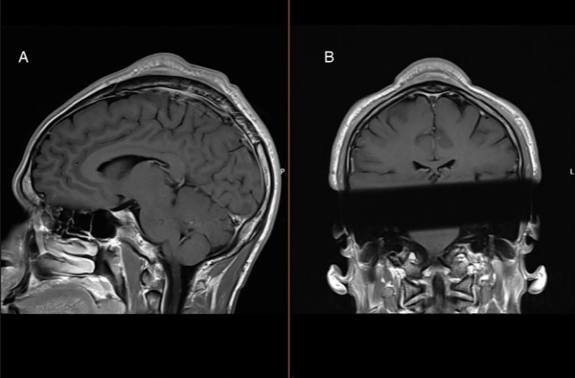   Christian Baastrup Søndergaard et al. / BMJ Case Reports, 2024