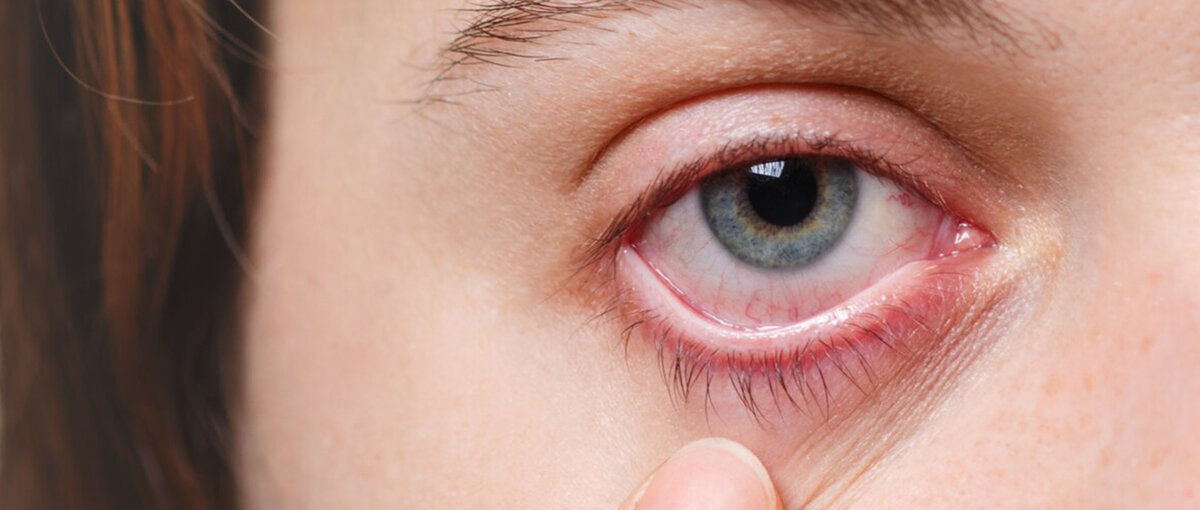 Сухие глаза могут быть следствием воздуха с низкой влажностью. 