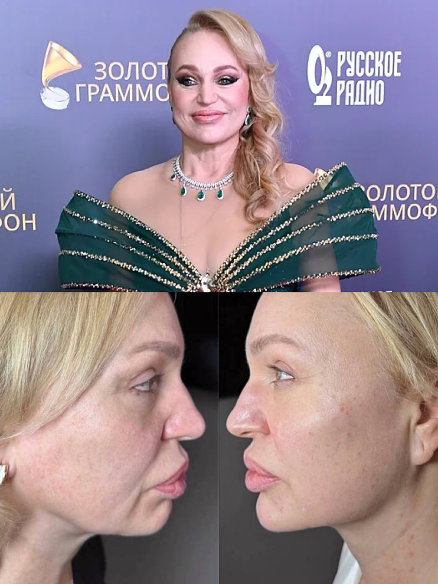 Алла Довлатова до и после