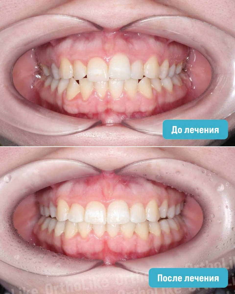 Исправление прикуса до и после лечения