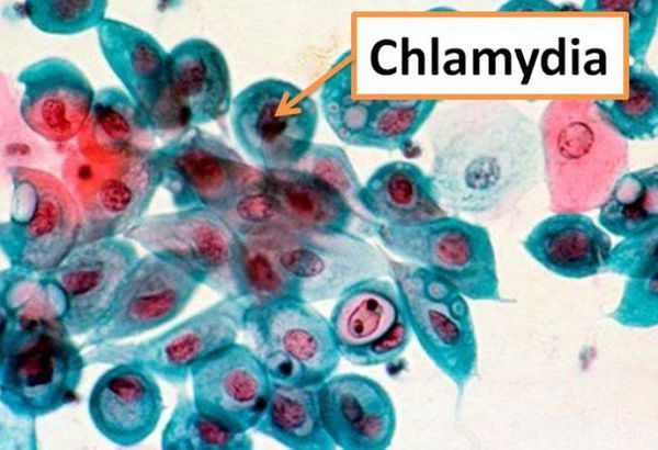 Chlamydia trachomatis