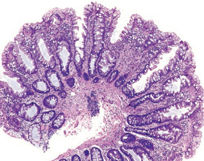 Гиперпластический полип
