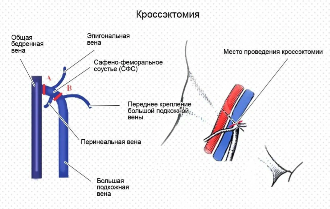 Операция троянова-тренделенбурга. Кросэктомия. Кроссэктомия троянова тренделенбурга. Кроссэктомия операция троянова тренделенбурга. Операция троянова-тренделенбурга.