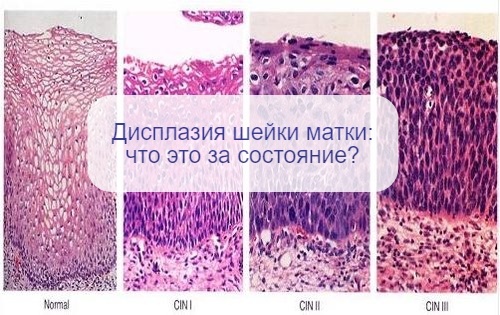 Еще не рак, но внимания требует - что такое дисплазия шейки матки и нужно ли ее лечить