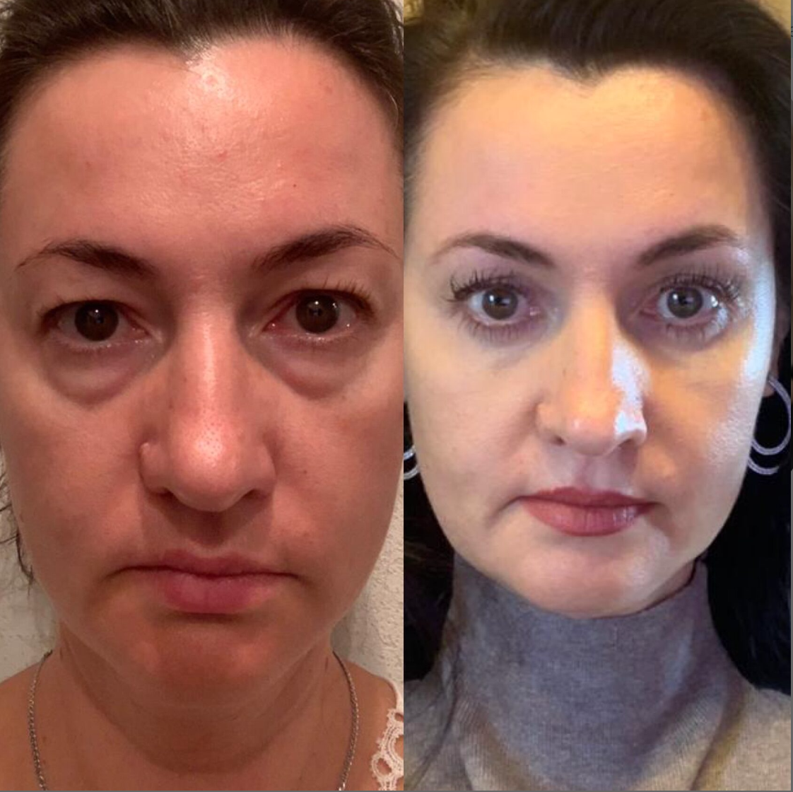 Результат комбинированной трансконьюктивальной блефаропластики. Хирург: Гулянский Н.С.