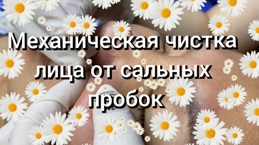 1. Механическая чистка лица от сальных пробок.