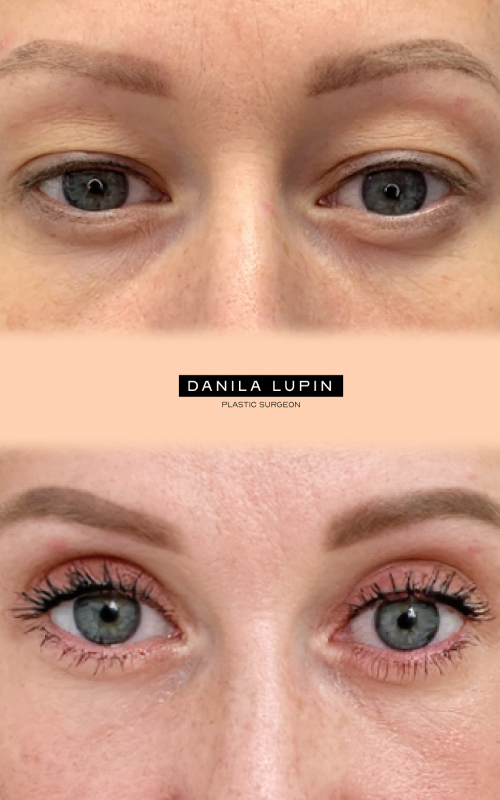 Блефаропластика. На фото пациентка Данилы Лупина. Имеются противопоказания, необходима консультация специалиста