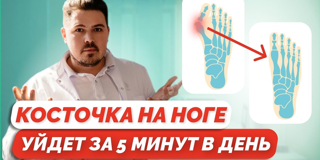 Косточка на ноге: эффективные методы устранения вальгуса