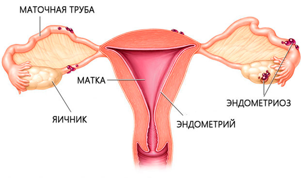 Очаги эндометриоза