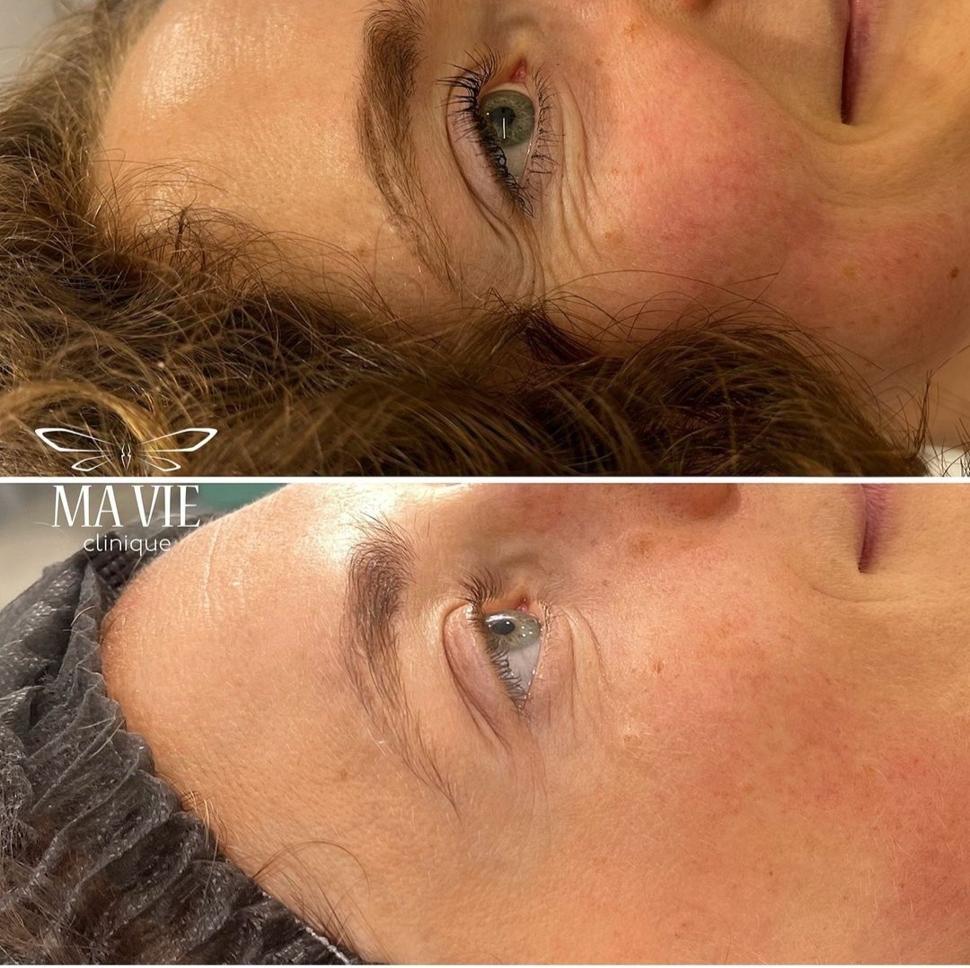 До/ после Virtue RF