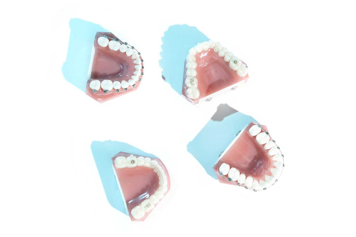 Брекеты и элайнеры 