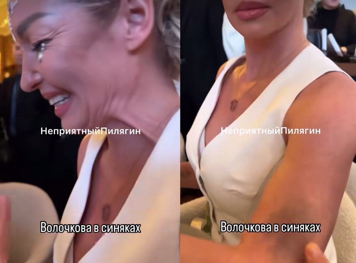 Травма Анастасии Волочковой заинтересовала журналистов. С такой прима появляется уже не в первый раз. Фото: "Неприятный Пилягин".