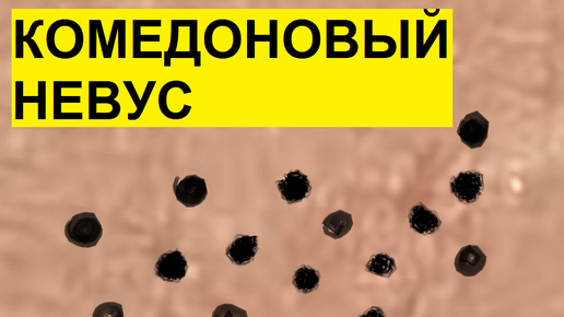 Каждый квадратный миллиметр в прыщах. Такое видел не каждый косметолог. Механическая чистка лица