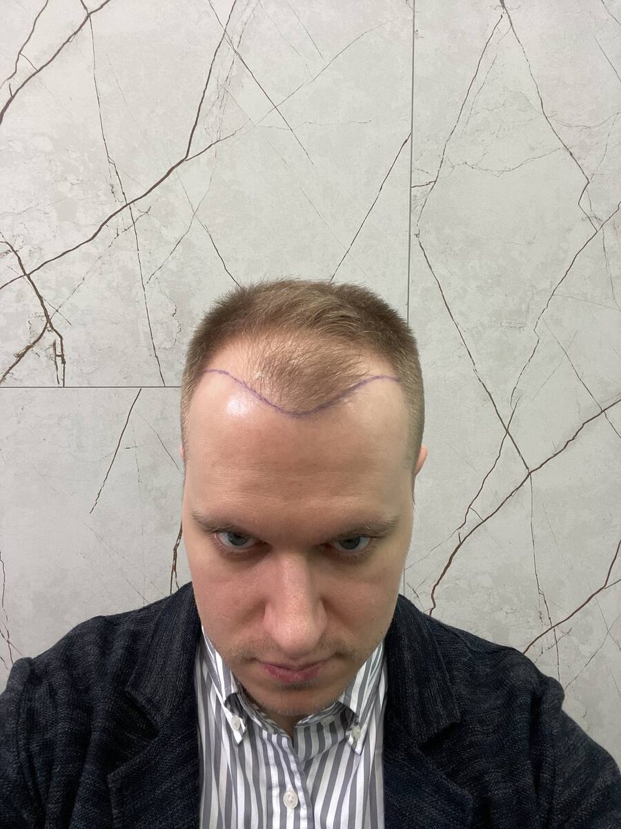 До пересадки волос