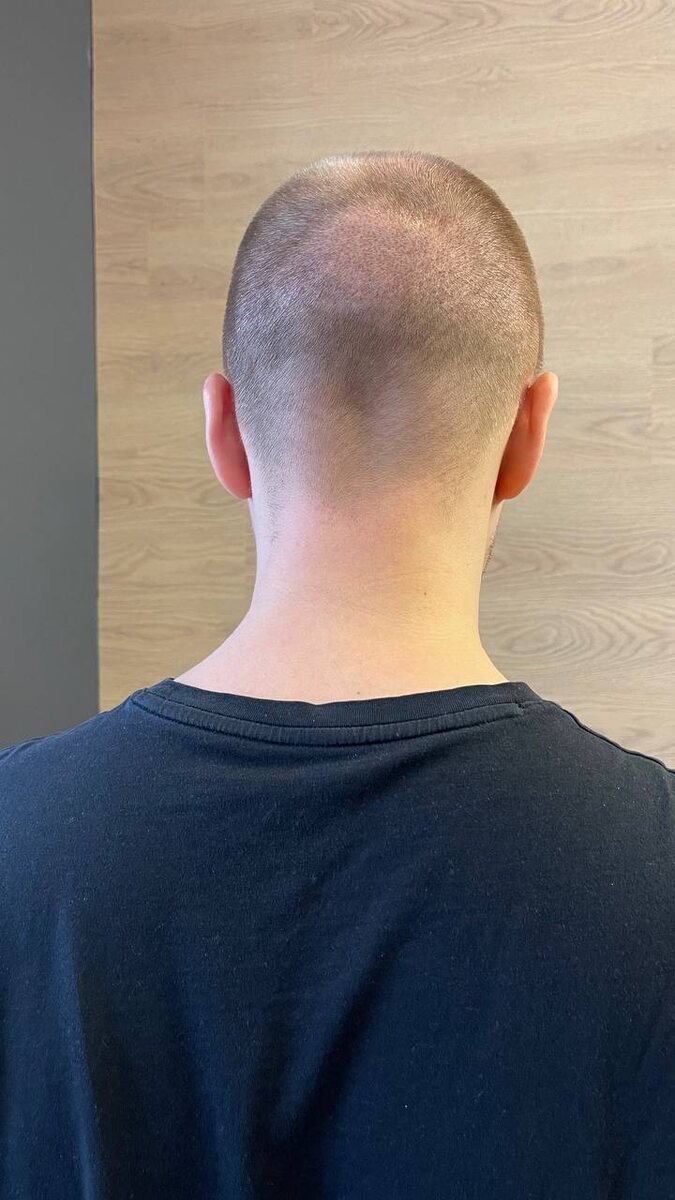 Мой затылок на 10-й день после пересадки