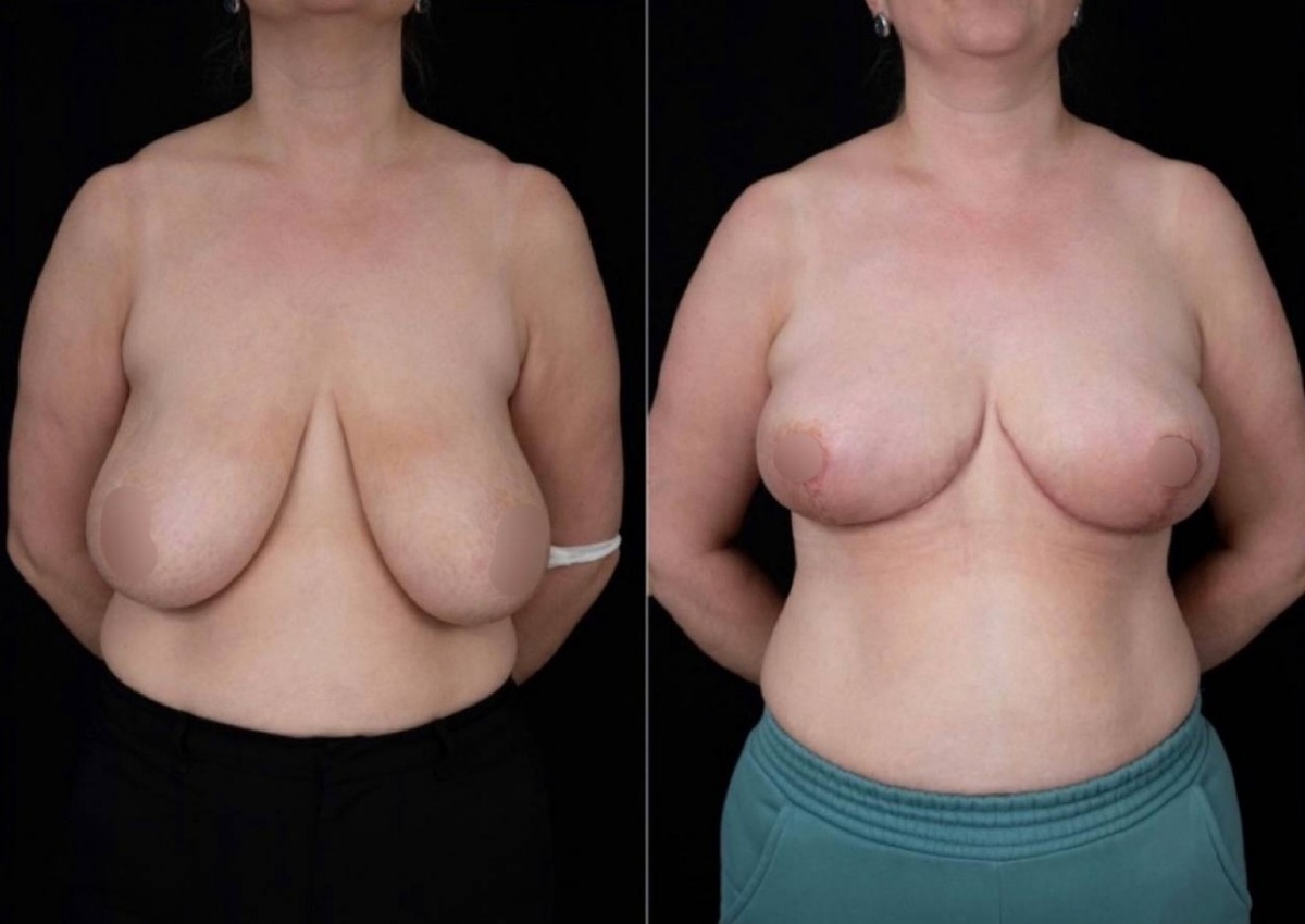 Фото до и после операции по уменьшению груди с якорной подтяжкой. Фото справа 1 месяц после операции.