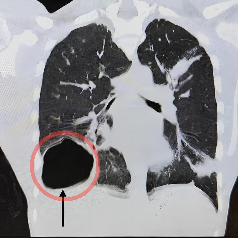    Вот так выглядела киста на рентгеновском снимке.пресс-служба МОЦОМД