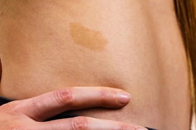    Почему у одних людей есть родимые пятна, а у других нет?