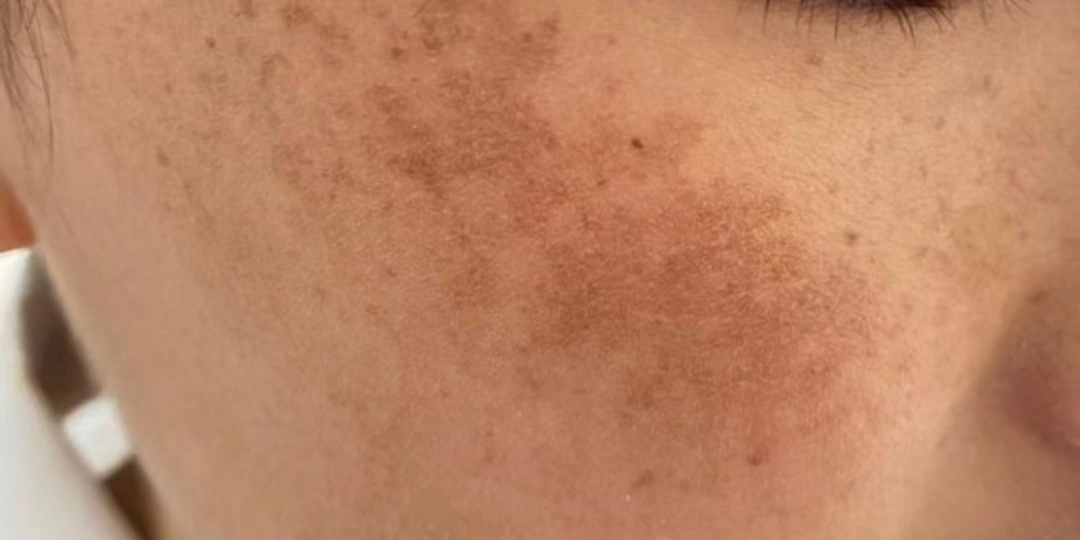 ПИГМЕНТАЦИЯ - ЭТО НЕ ПРО ВОЗРАСТ!