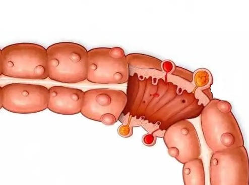 Рис. 01. Дивертикулит толшстой кишки. Изображение из свободного доступа.