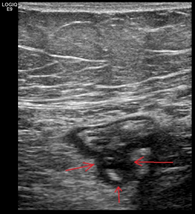 Рис. 02. Поперечное изображение сигмовидной кишки. Дивертикул на задней стенке с утолщенными стенками.