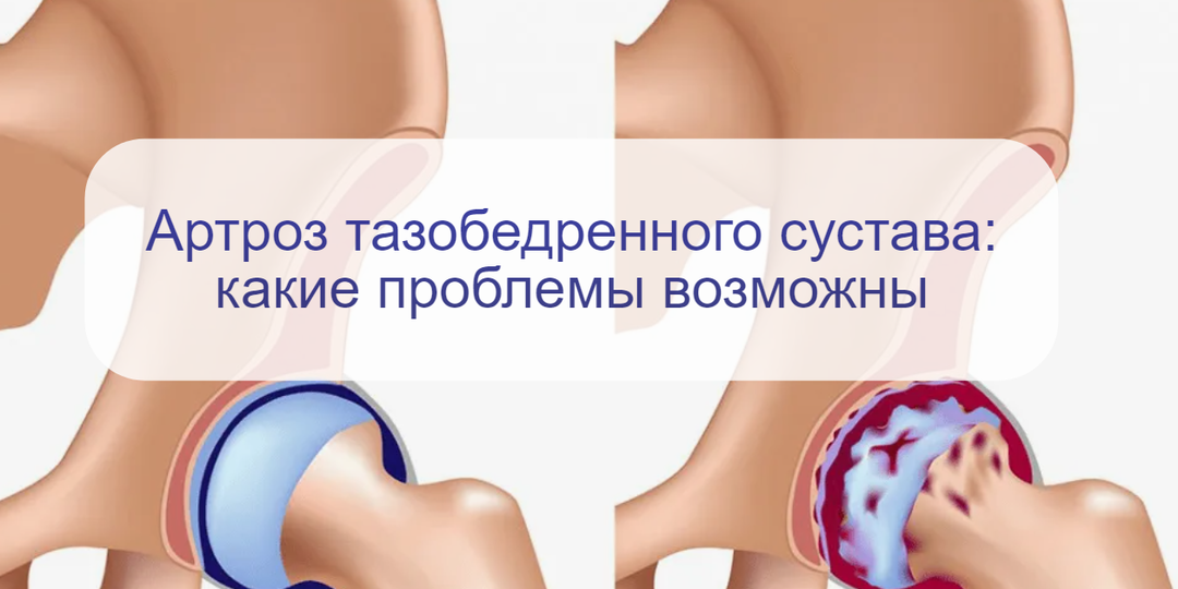 Врач отвечает: 4 главных вопроса об артрозе тазобедренного сустава у взрослых – вы могли этого не знать