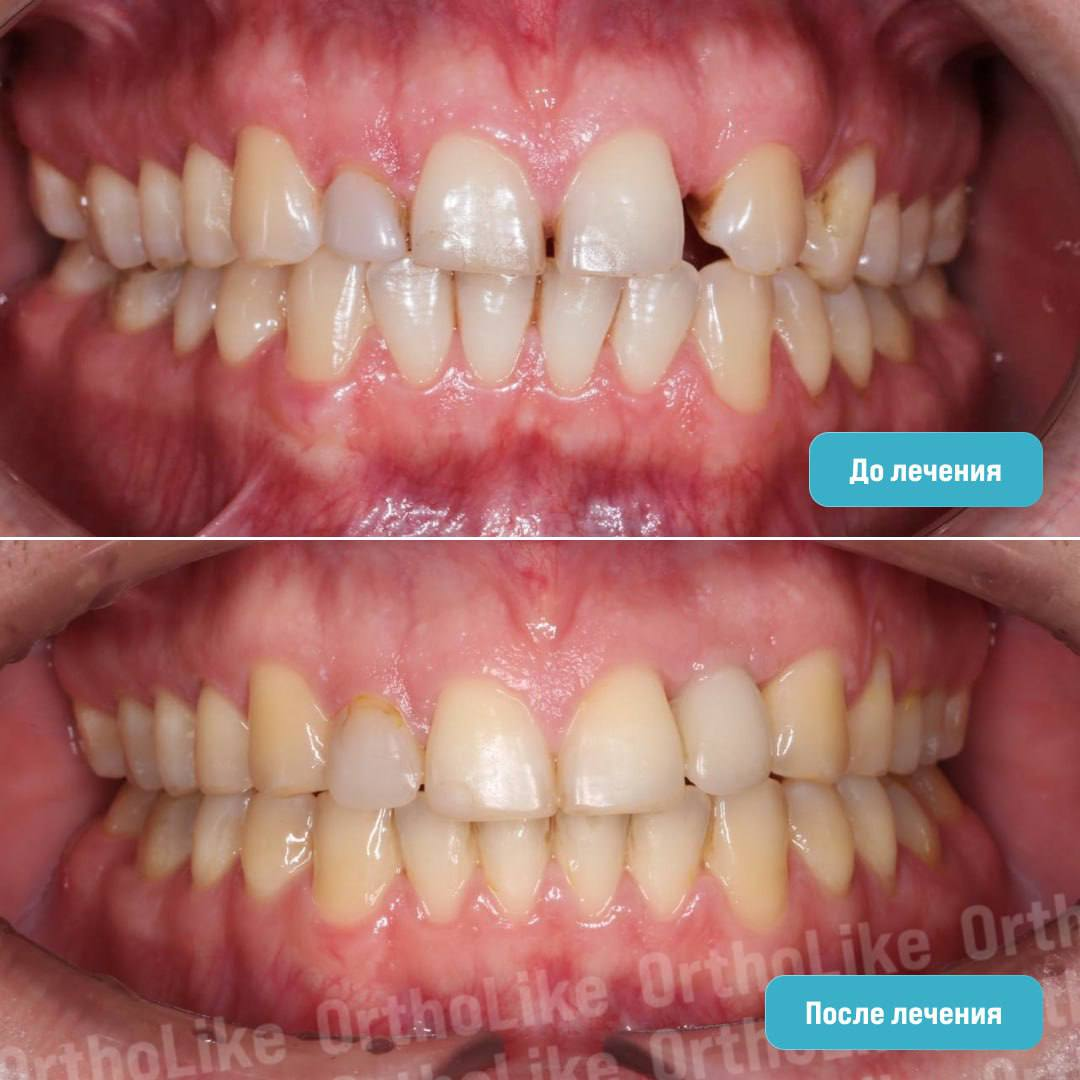 До и после ортодонтического лечения