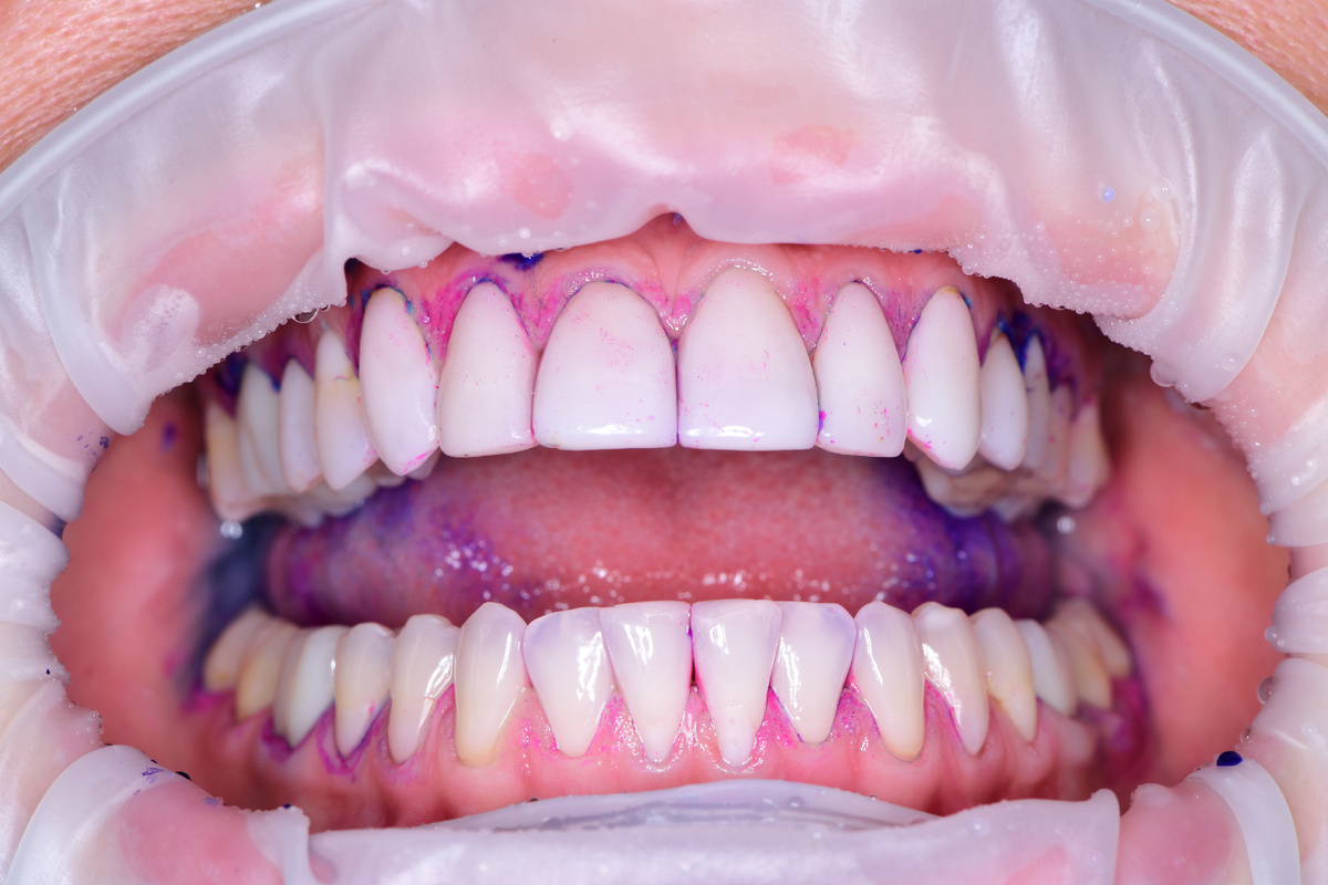 Индикация налёта — отличительный знак Качественной профессиональной гигиены