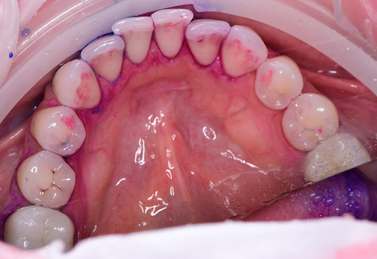 Налет и зубной камень при скученности нижних зубов