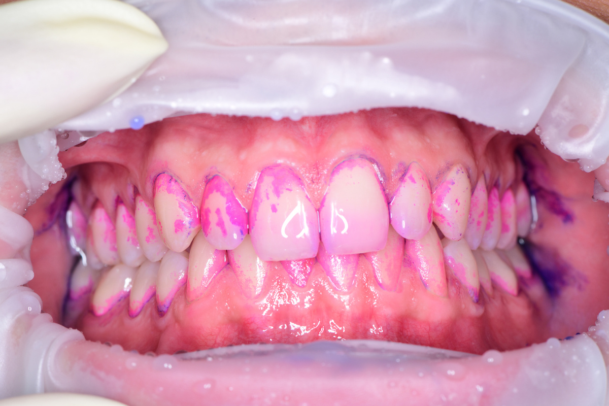 Индикация зубного налета и отложений 