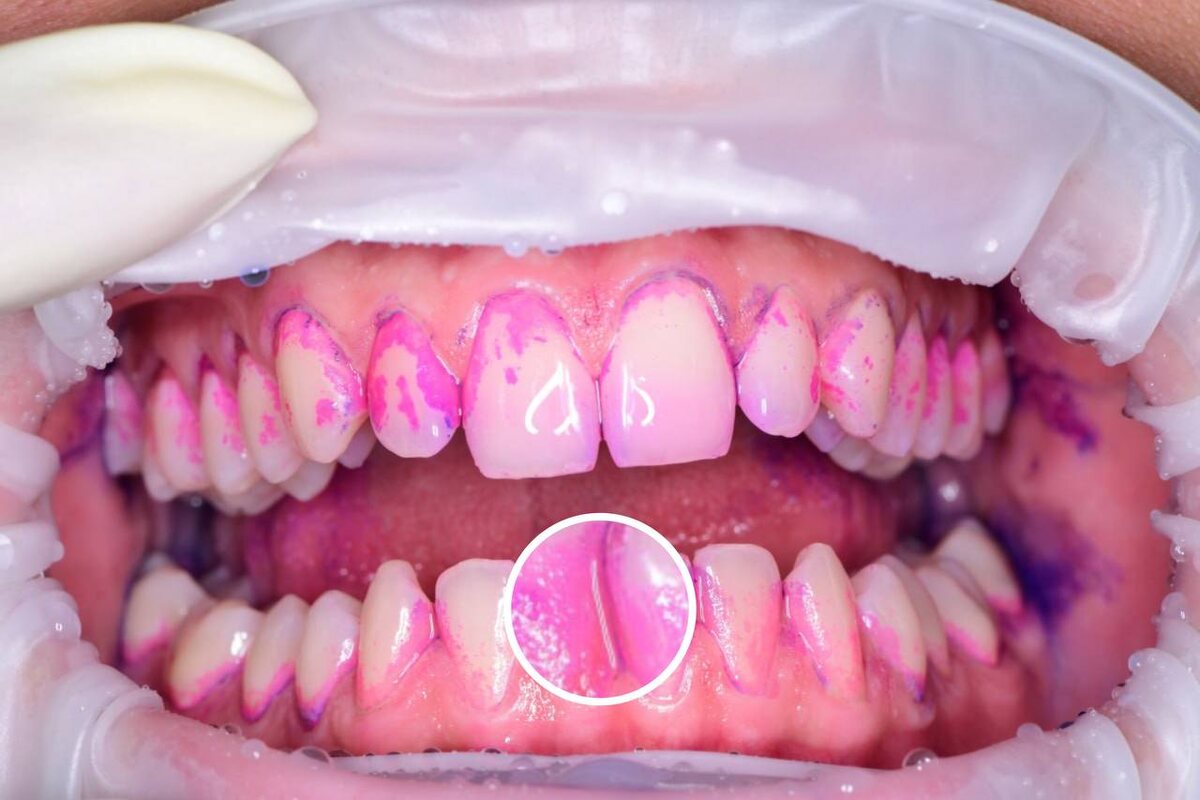 Налет, который скапливался в течение одного дня 