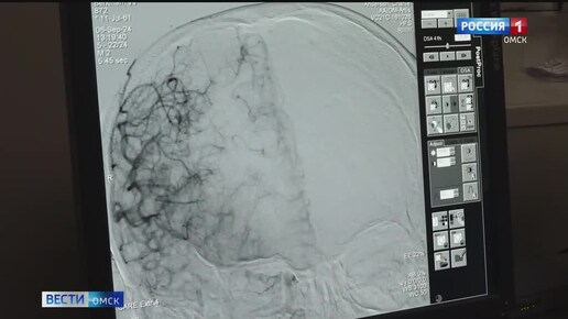 Омские врачи спасли пациента от неминуемого инсульта