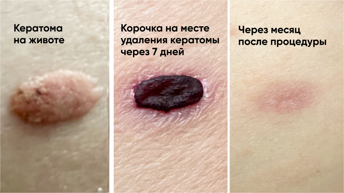 Лазерное удаление кератомы на животе