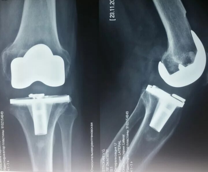 Эндопротез коленного сустава. Фото из интернета