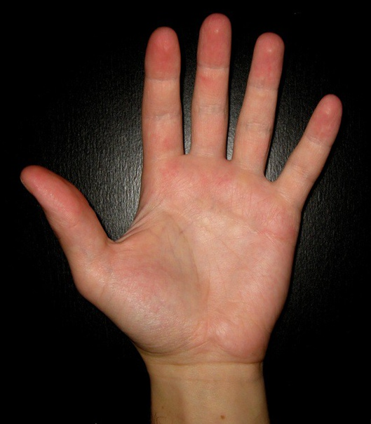 Красные верхние фаланги пальцев - знак риска склонности к скачкам давления. ВКонтакте