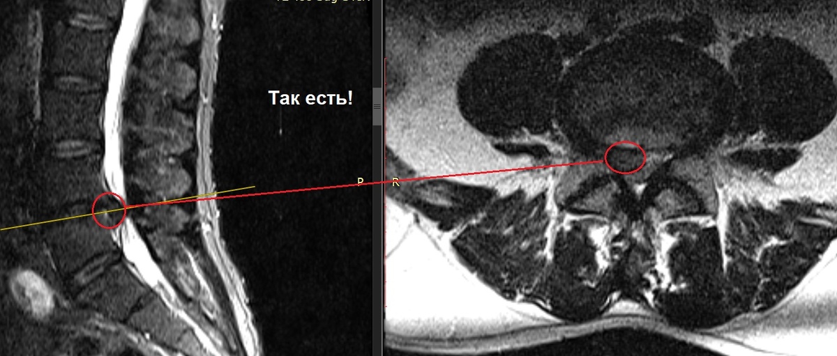 Грыжа диска LIV-V, парафораминальная (со смещением от от центра) вправо, с признаками компрессии корешка L:4 на этом уровне.
