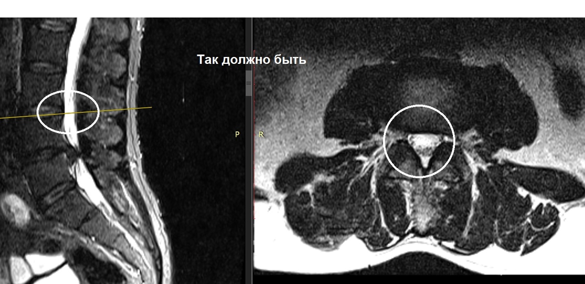 Срез на уровне LIII-IV - абсолютная возрастная норма (незначительные дегенеративные изменения межпозвонкового диска)