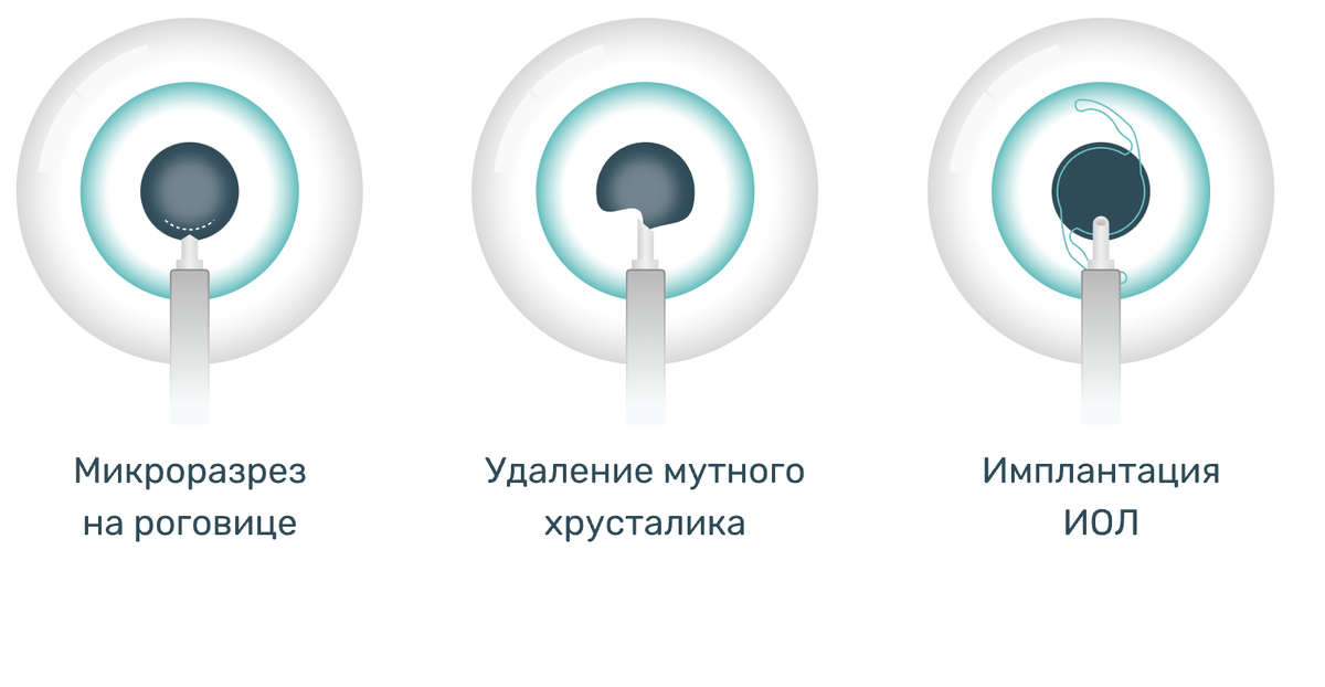 КАК ПРОХОДИТ ИМПЛАНТАЦИЯ ИОЛ
