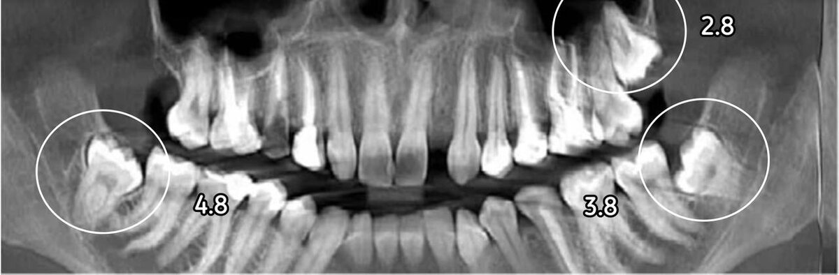 Зубы под удаление