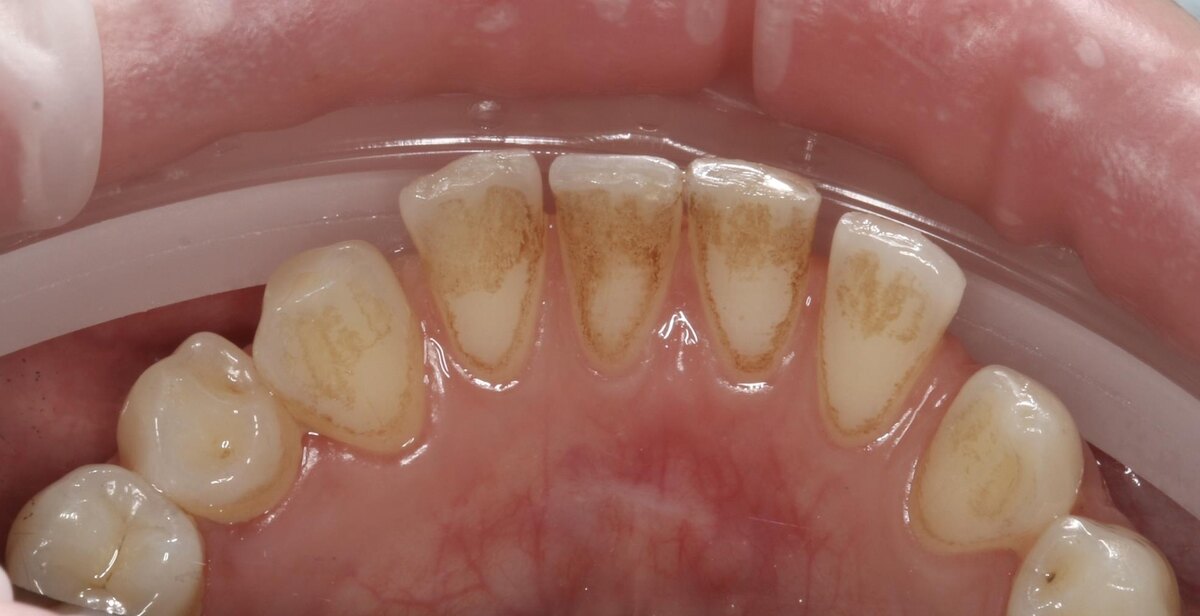 Пигмент от напитков и табака нельзя убрать дома, не повредив эмаль