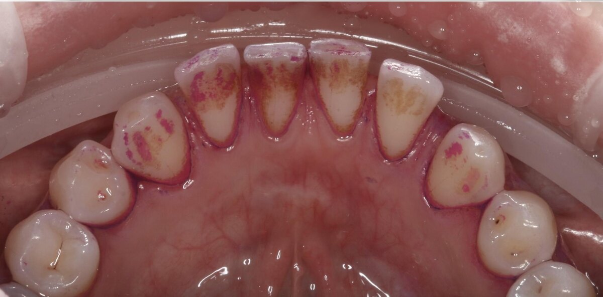 Покрасили отложения для лучшей оценки ситуации