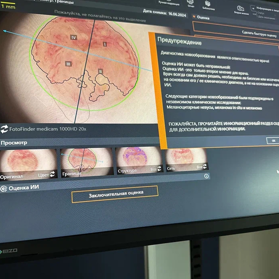 Компьютерная диагностика новообразований кожи FotoFinder